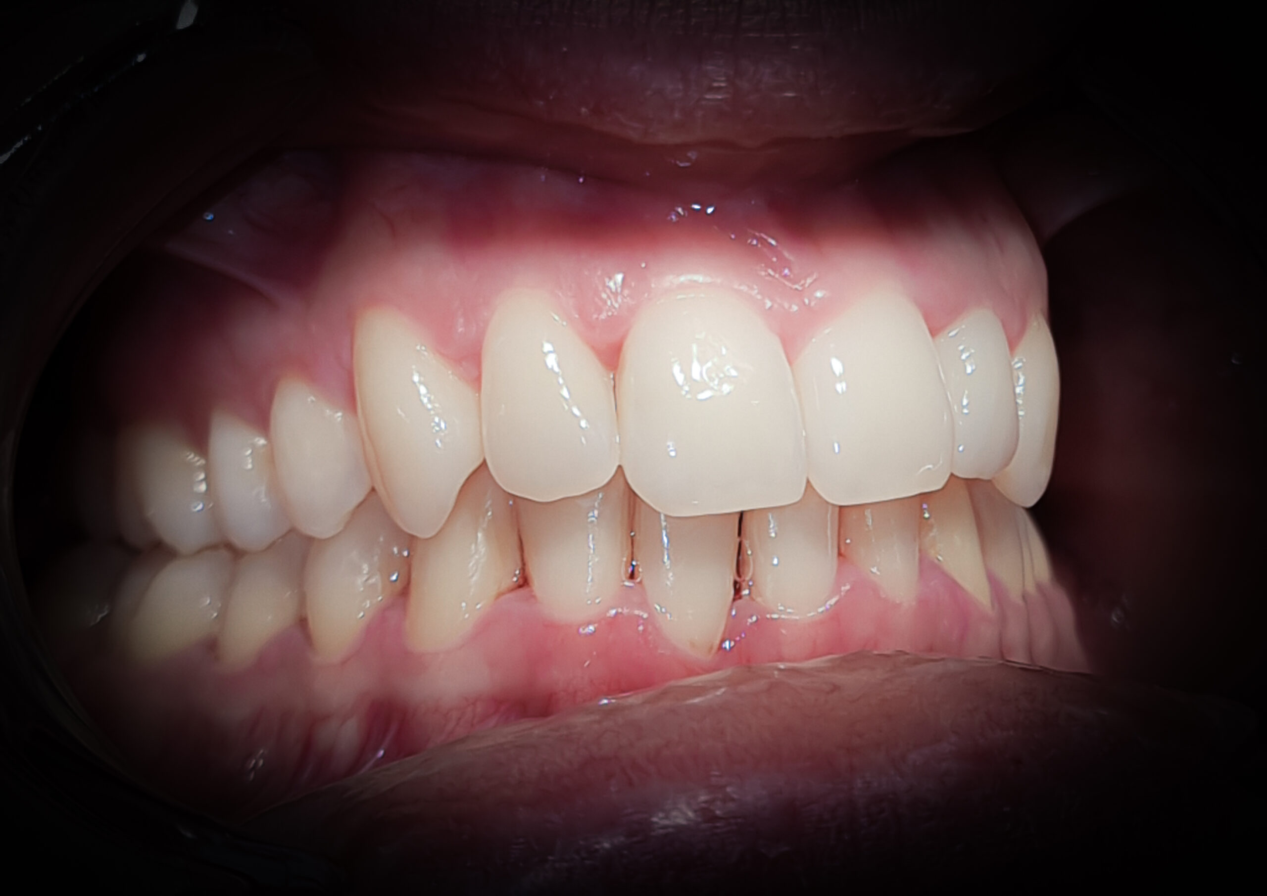 torlodas_overjet_overbite