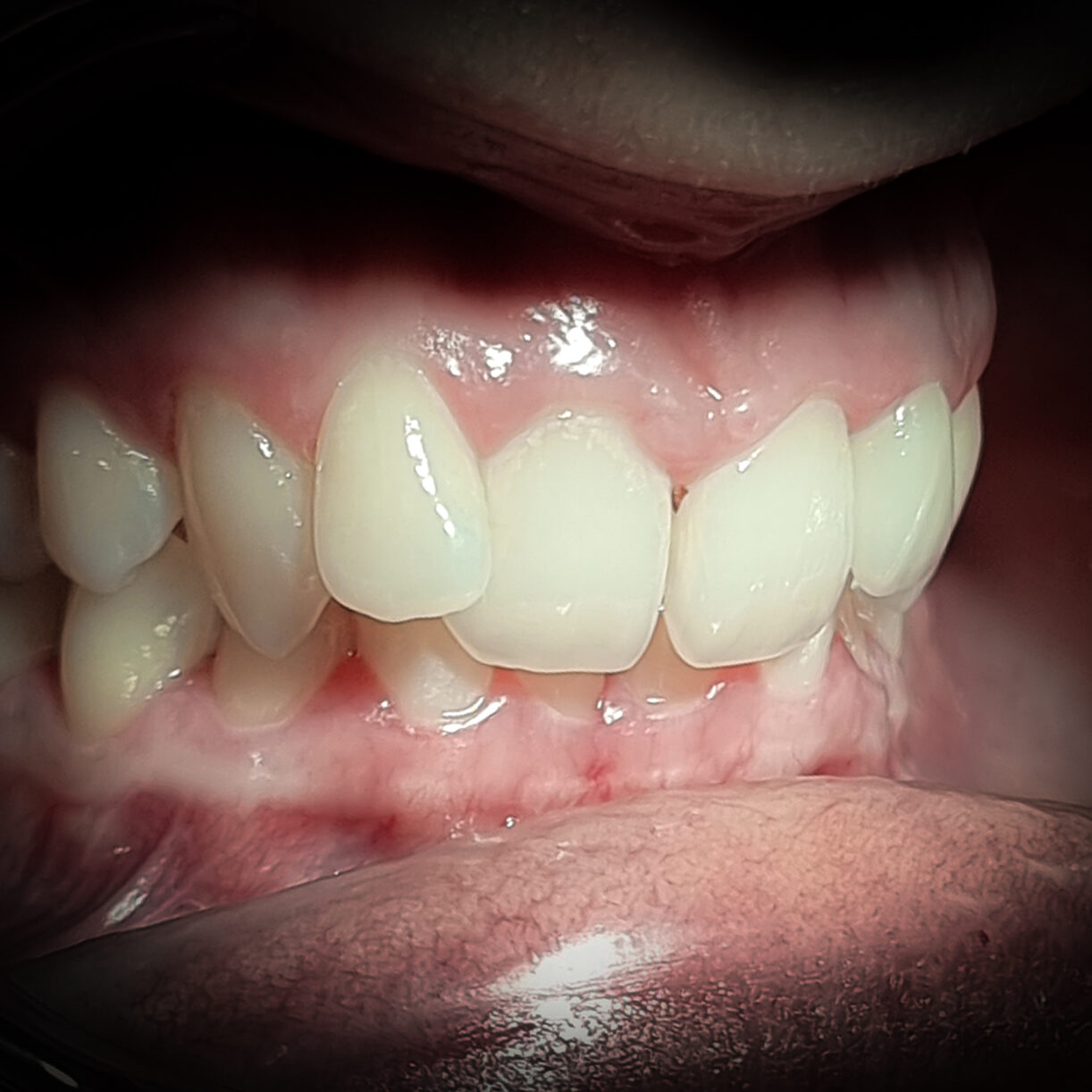 torlodas_overjet_overbite-2