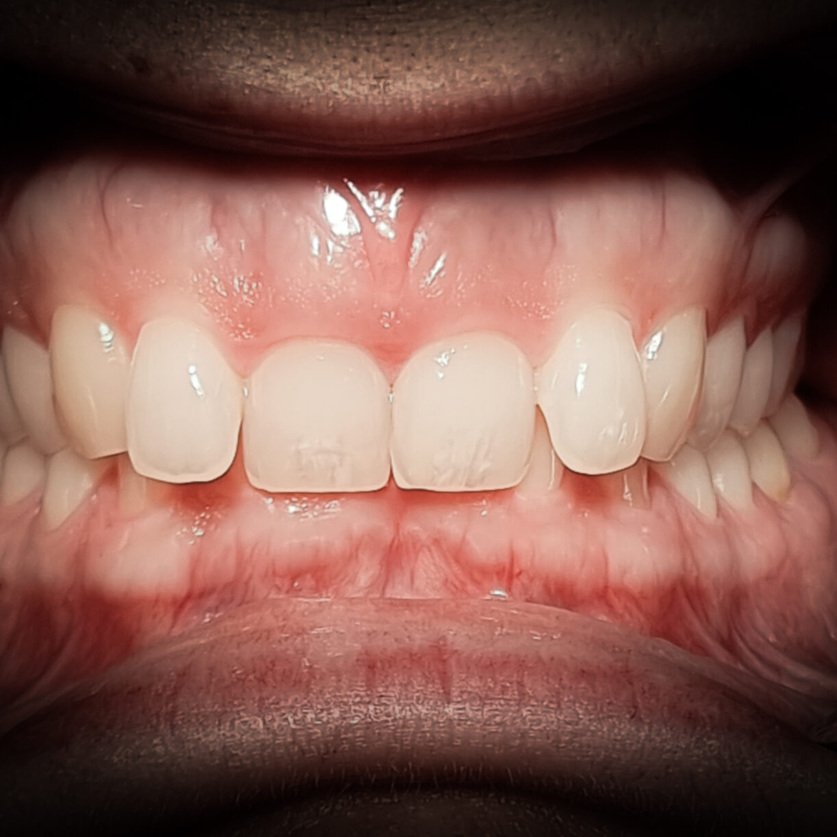 overbite_torlodas